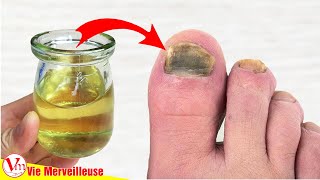 Comment Enlever Les Mycoses Des Ongles Des Pieds Rapidement Et Naturellement  Remèdes Maison [upl. by Travax414]