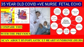 CRITICAL AORTIC STENOSIS IN THE FETUS OF A 35 YEAR OLD COVID POSITIVE NURSE PLS ANALYSE WITH HLHS [upl. by Cilo861]