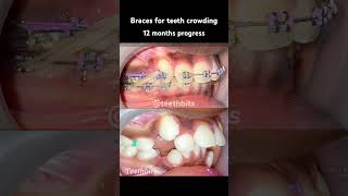 Crooked teeth Braces in 12 months progress braces orthodontics dental dentist teethbits [upl. by Arata617]