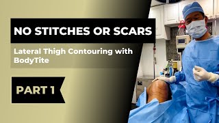 No Stitches or Scars  Lateral Thigh Contouring with BodyTite  Radiofrequency Treatment  PART 1 [upl. by Ehudd]