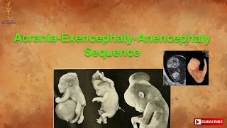 AcraniaExencephalyAnencephaly Sequence [upl. by Lavud422]