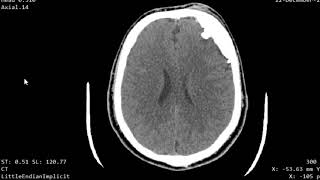 CASE 955 CT BRAIN Hyperostosis Frontalis Interna [upl. by Llenal]