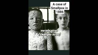 One of the most dangerous diseases Smallpox mbbs [upl. by Ailekat]