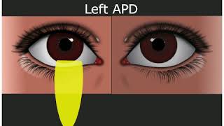 Relative Afferent Pupillary Defect  Medical Student Education [upl. by Nosauq648]