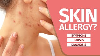 What is Skin Allergy Symptoms Causes Diagnosis and Triggers [upl. by Yliram74]