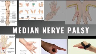 Median Nerve palsy  Anatomy CausesClinical featuresDeformity Special test Pt management [upl. by Atinek]