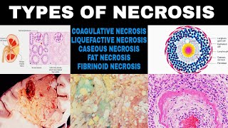 NECROSIS  PART  2  Types Of Necrosis [upl. by Thorstein]