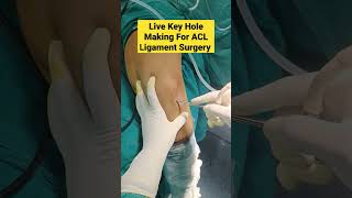 Arthroscopic surgery for knee [upl. by Rankin]