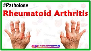 Rheumatoid arthritis Animation  Etiology Signs and Symptoms Pathology Diagnosis and Treatment [upl. by Altman]