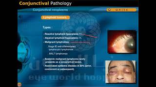 conjunctival neoplasms [upl. by Nahtaj550]