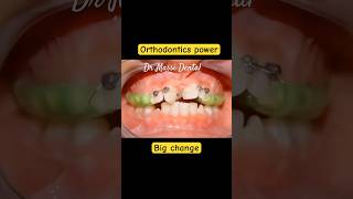 Orthodontics power Braces on crowding teeth [upl. by Nylzzaj458]