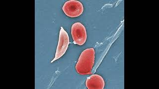 Sickle Cell Disease in the ED [upl. by Onitnerolf575]