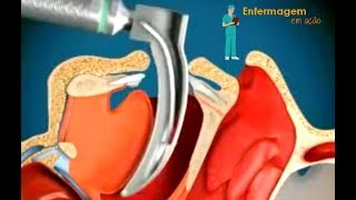 Intubação endotraqueal IOT  Conhecimento nunca é demais [upl. by Israel]