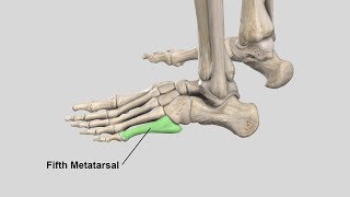 Surgical Management of Fifth Metatarsal Jones Fractures Intramedullary Screw Fixation [upl. by Harutek152]