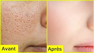 Voici comment Supprimer les pores dilates du visage  Allez Santé [upl. by Kahle]