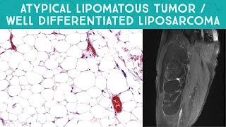 Well differentiated liposarcoma  quotAtypical lipomatous tumorquot mimicking lipoma Oregon Case 13 [upl. by Helse]