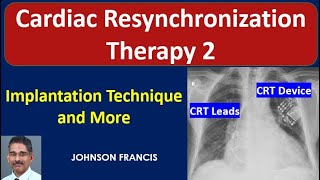 Cardiac Resynchronization Therapy  Implantation Technique and CRT Implantation Pearls from Experts [upl. by Latnahc]