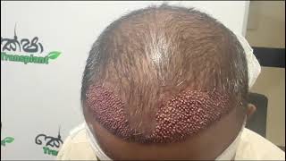 හිසකෙස් බද්ධ කිරීමේ තාක්ෂණය ගැන ඉගෙන ගන්න learn about Sapphire Hair Transplant Technology 0769965660 [upl. by Enahs533]