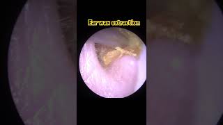 Check out this ear wax removal 😊Super satisfying [upl. by Ebsen]