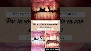 Restaurations par la résine composite des dents antérieures en une seule séance dentist [upl. by Lurlene]