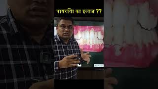 पायरिया का इलाज  gumdisease shorts [upl. by Adnomal182]