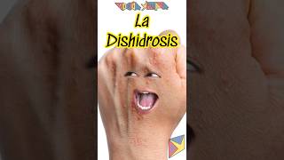 La Dishidrosis 😱 Explicado shortvideo [upl. by Kaliski]