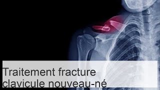 Fracture de la clavicule chez un nouveauné à la naissance  conséquences pour lenfant [upl. by Monia]