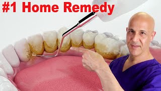 1 Home Remedy to Remove Dental Plaque amp Tarter to Prevent Cavities  Dr Mandell [upl. by Nitnert]