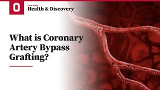 What is Coronary Artery Bypass Grafting CABG  Ohio State Medical Center [upl. by Meeharb]