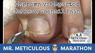 👣Its Mr Meticulous  How to Pedicure an Ingrown amp Impacted Toenail Pain👣 [upl. by Ssew]