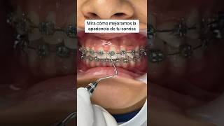 Así realizamos una gingivectomía 😀 [upl. by Gardie]