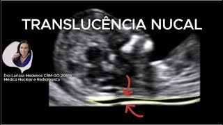 TRANSLUCÊNCIA NUCAL  Ultrassom obstétrico [upl. by Idnas]