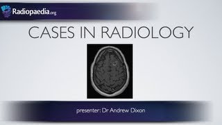 How to use acronyms in Radiopaedia cases and articles [upl. by Lebana]