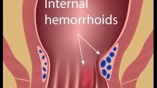 Hemorrhoid Treatment with Colorectal Surgeon Dr Jennifer Lowney [upl. by Killoran85]