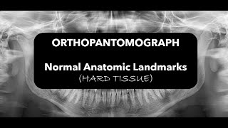 Hard tissue landmarks in OPG [upl. by Toft320]