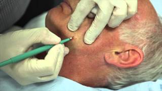 How to remove facial warts using Cautery [upl. by On]