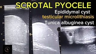 Complex hydroceleScrotal pyocele epididymal cyst testicular microlithiasis Tunica albuginea cyst [upl. by Utir]