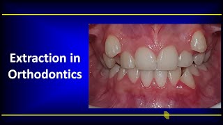 Extraction in Orthodontics [upl. by Niamert]