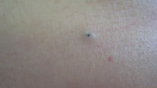 Dilated Pore Treatment [upl. by Winfield]