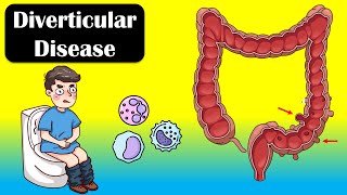 Diverticular Disease And Diverticulitis  Causes Signs amp Symptoms Diagnosis Treatment [upl. by Alol]