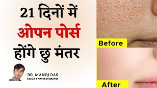 21 दिनों में खत्म Clogged Pores Blackheads Bumps Whiteheads and Large Pores I DR MANOJ DAS [upl. by Annaira]