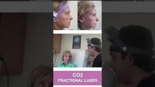 CO2 Fractional Laser Resurfacing [upl. by Stiles]