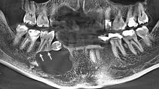 Enucleation of dentigerous cyst  dentistry  surgery  cyst  supernumerary teeth  amazing [upl. by Alodie]