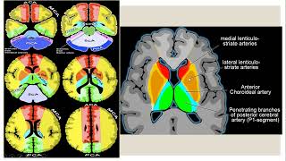 Neuroradiology case presentation session 2 [upl. by Gage827]