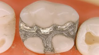 Class II MODL amalgam filling restoration [upl. by Airres]