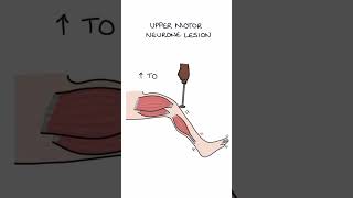 Motor lesions [upl. by Llennehc]