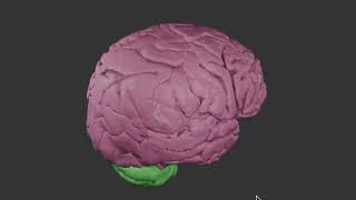 Parietal tumor [upl. by Capon]