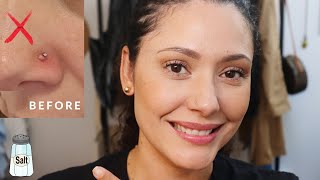 HOW TO GET RID OF NOSE PIERCING KELOID NOSE RING BUMP HOME REDEMY [upl. by Beverlie]