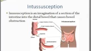 Intussusception and Volvulus [upl. by Roi]