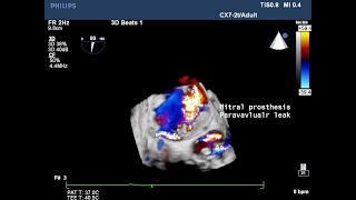 Paravalvular leak of mitral prosthesis [upl. by Addiel]